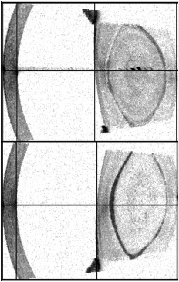 Bilateral implantation of a non-diffractive extended depth of focus intraocular lens in a pediatric patient with lamellar cataract.