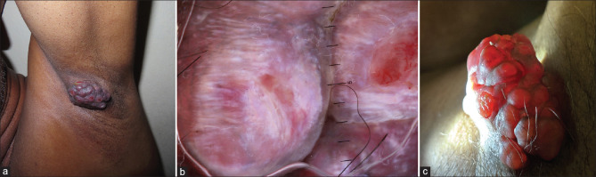 Primary Cutaneous Mucinous Carcinoma: A Rare Entity.
