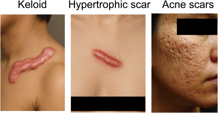 A Comprehensive Review of Predictive Precision in Scar Medicine: From Molecular Predictors to Machine Learning Models.