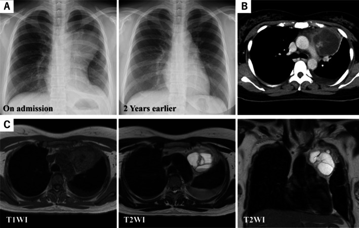 Hemiclamshell Resection of a Ruptured Mediastinal Teratoma Exhibiting Pancreatic Differentiation.