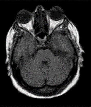 Cerebral Venous Thrombosis Following Periocular Filler Injection-A Case Report and Review of Literature.