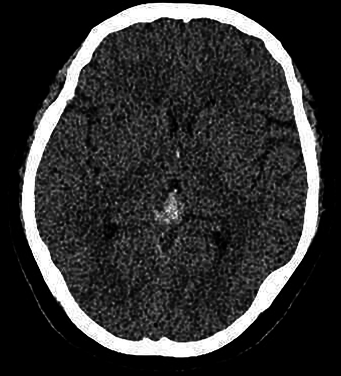 Primary malignant melanoma of the pineal region: illustrative case.