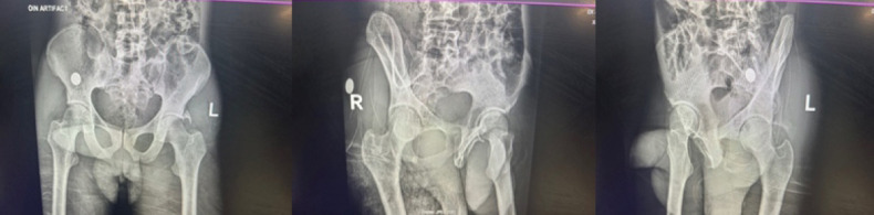 Asymmetrical Bilateral Complex Dislocations of the Hips: A Rare Case Report.