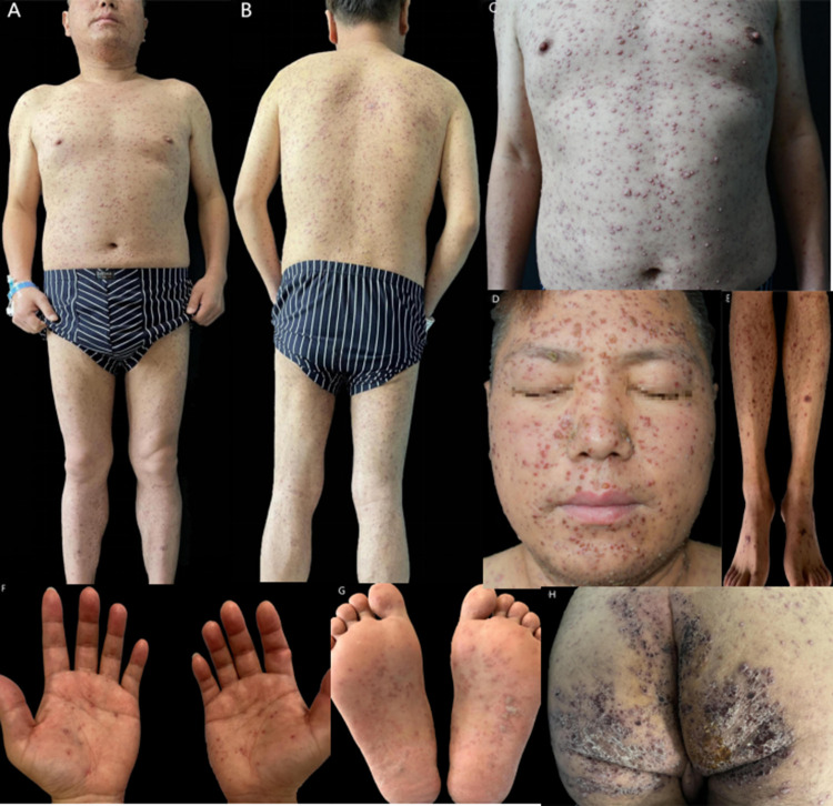 A Case of Generalised Varicella in an Adult.