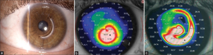 A comparative study of two intrastromal corneal ring segment models in keratoconus: A retrospective study.