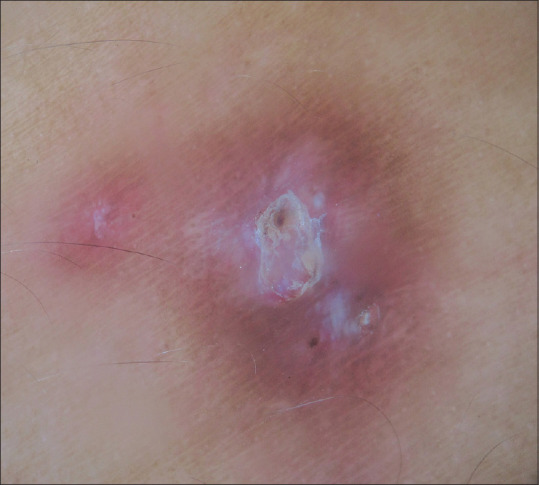 Trans-Epidermal Elimination Due to Insulin Formulation: Report of a Rare Adverse Effect.