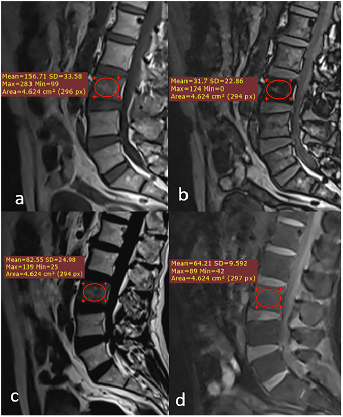 Quantitative MRI Dixon signal drop and fat fraction for differentiating bone marrow lesions: a two-center prospective analysis.