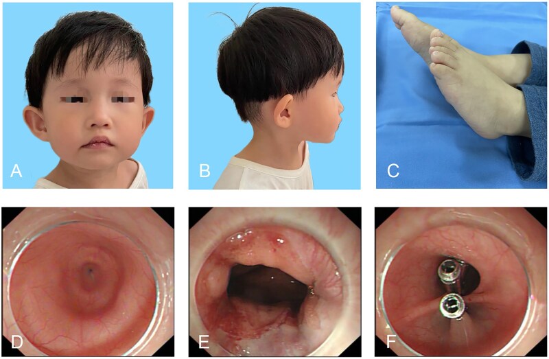 Achalasia and mental retardation in a child with uniparental disomy of <i>GMPPA</i> treated with POEM.