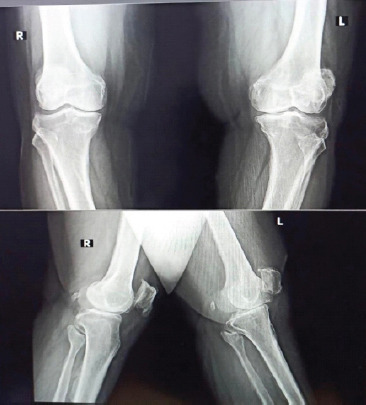 Rare Case of Heterotopic Ossification Impinging on the Quadriceps Mechanism Following Total Knee Replacement: A Case Report.