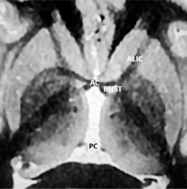 Stimulation of bed nucleus of the stria terminalis area for treatment-resistant obsessive-compulsive disorder and comorbid depressive and anxiety symptoms: a systematic literature review.
