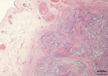 A Rare Case of Primary Signet Ring Cell Carcinoma of the Urinary Bladder in a Young Woman.