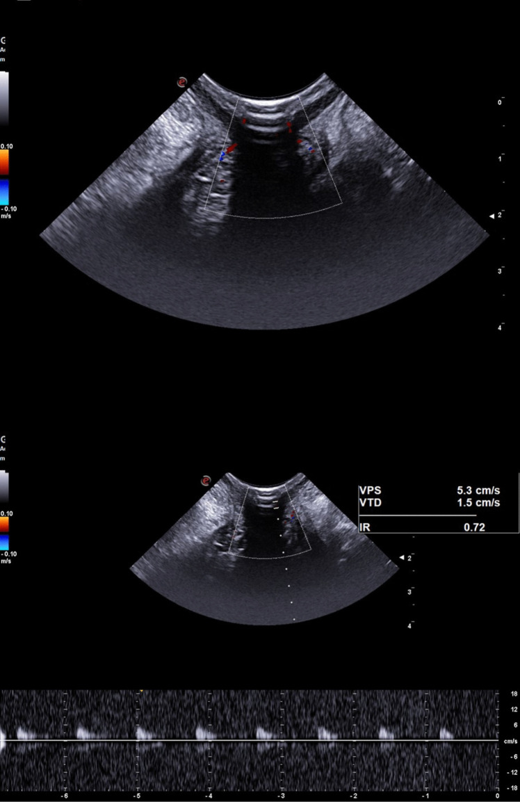 Arterial flow in healthy individuals and patients with hemorrhoidal disease: a Doppler ultrasound-based pathophysiological analysis.