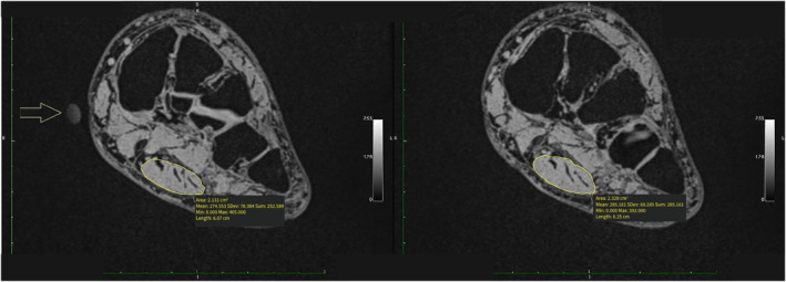 Validity of MRI and Ultrasound Volume Measurements of Foot Muscles and Plantar Fascia Cross-Sectional Area Within Older Adults With and Without Chronic Plantar Fasciitis.