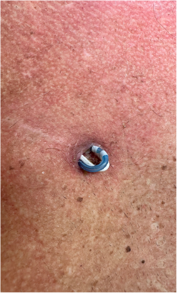 Hypoglossal Nerve Stimulator Lead Extrusion: Successful Management and Reimplantation.