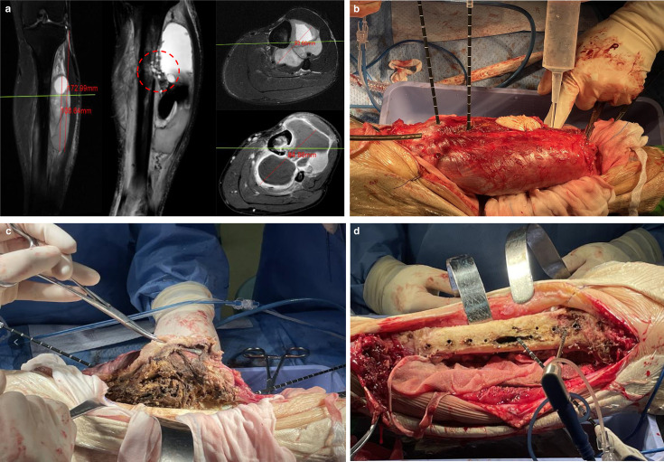 Limb-sparing surgery combined with local inactivation by ablation improves local control in soft-tissue sarcomas : a comparative study with long-term follow-up.