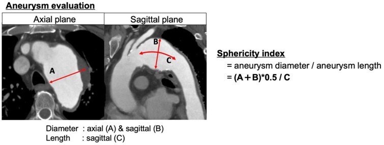 Aneurysm Shape and Sac Shrinkage After Total Arch Replacement With Frozen Elephant Trunk for True Aortic Arch Aneurysm.