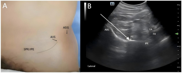 Pericapsular Nerve Group Block for Hip Fracture Pain Management: A Narrative Review of Emergency Applications.