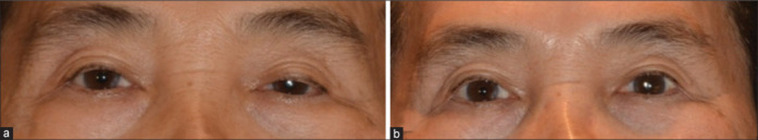 Impact of unilateral Mueller's muscle conjunctival resection on contralateral upper eyelid position in patients without preoperative Hering's effect.