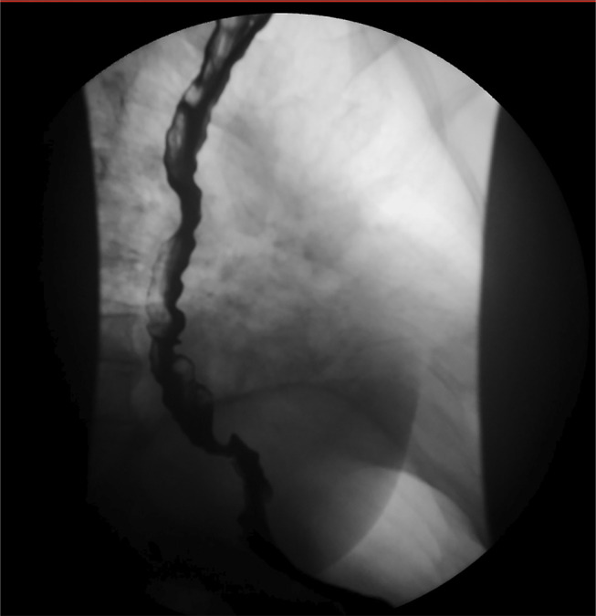 Where the Jackhammer Meets the Corkscrew: A Case of Manometric Hypercontractile Esophagus and Esophagogastric Junction Outflow Obstruction With Endoscopic Features of Distal Esophageal Spasm.