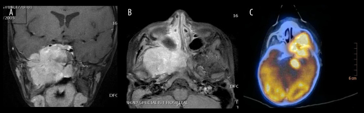Retrospective Study of Pediatric Sinonasal Tumors in a Tertiary Hospital Setting.