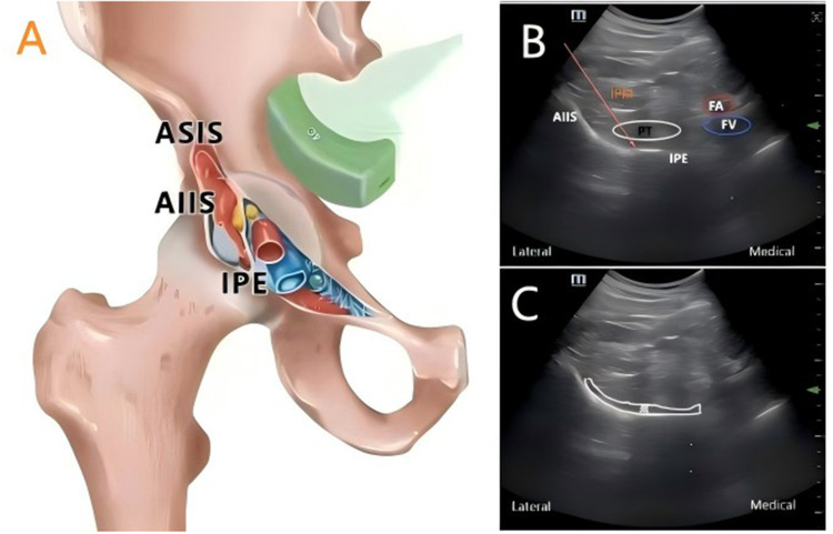 Pericapsular Nerve Group Block for Hip Fracture Pain Management: A Narrative Review of Emergency Applications.