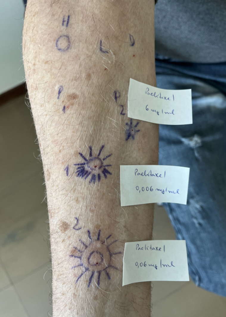 Successful desensitization in paclitaxel-induced anaphylaxis: The role of skin testing and environmental sensitization.