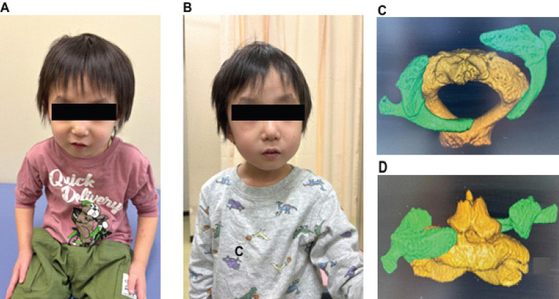 A Case of Atlanto-Axial Rotatory Fixation Requiring Internal Fixation.
