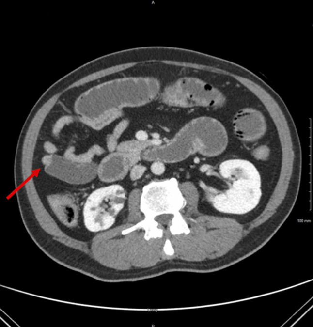 Psyllium Overdose During Bowel Preparation Leading to Pneumatosis Intestinalis.