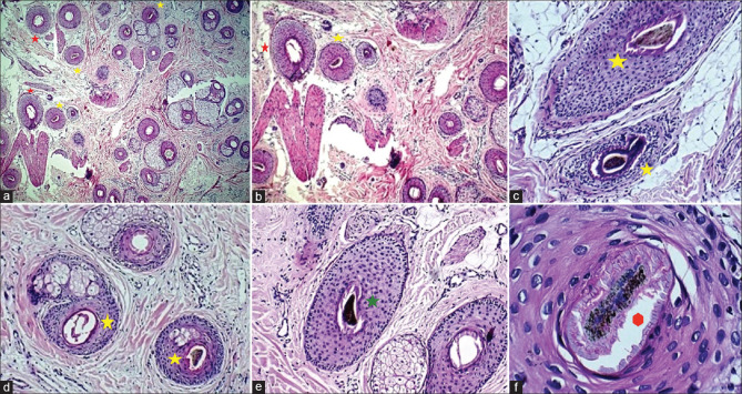 Trichotillomania Incognita in an Adult Female: A Great Mimicker Worth Attention!