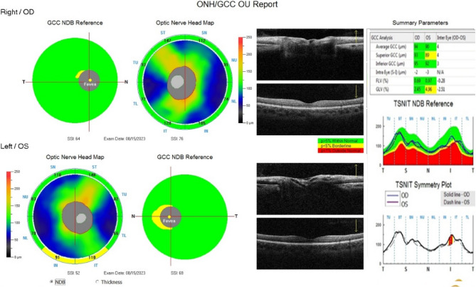 Evaluation of ganglion cell complex in patients taking hydroxychloroquine.