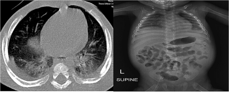 Infantile systemic Hyalinosis in a 6-month-old male: identification of homozygous ANTXR2 gene mutation.
