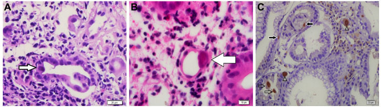 Cytomegalovirus Detection by PCR on Fresh and Formalin-Fixed Colon Tissue Biopsies of Children with Colitis: A Prospective Cohort Study.