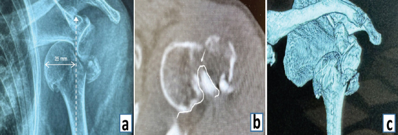 Irreducible Anterior Shoulder Dislocation with Greater Tuberosity Fracture: Joystick Reduction and Biceps Preservation in an Elderly Female -A Case Report.