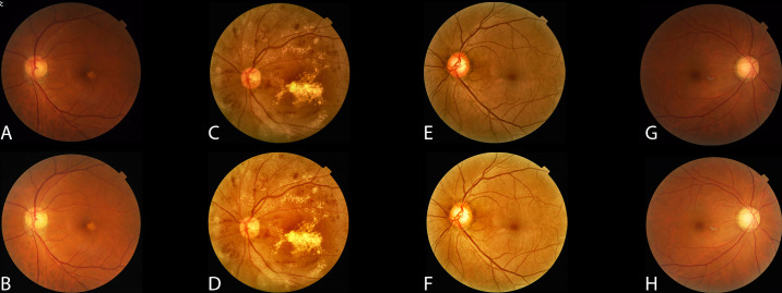 Code-Free Machine Learning for the Detection of Common Ophthalmic Diseases.