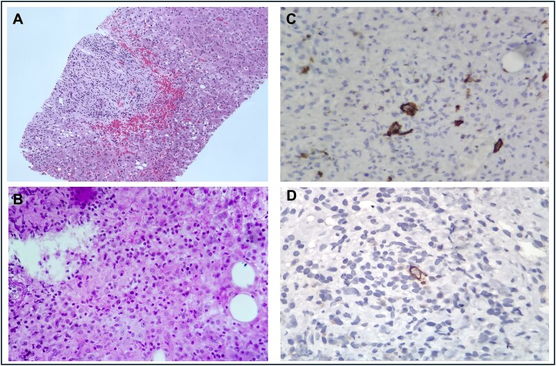 Acute liver injury as a manifestation of granulomatous hepatitis: diagnostic challenges.