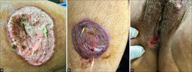 Distinct Post-partum Phenotype of Neutrophilic Dermatoses: Therapeutic Triumph in a Rare Scenario.