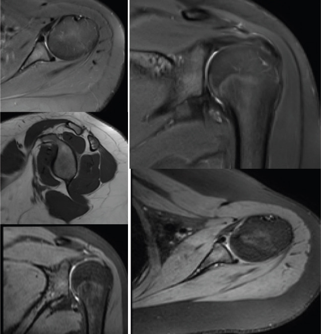 Atypical Idiopathic Inferior Functional Shoulder Instability in a 15-year-old Female: A Case Report and Review of Literature.