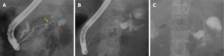 Transpapillary drainage of pancreatic fluid leakage <i>via</i> a rigid trans-tumoral tract using a drill dilator: A case report.