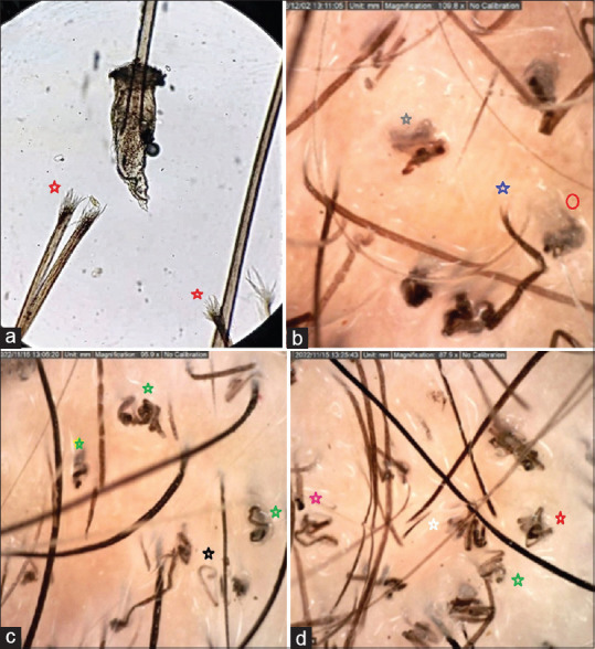 Trichotillomania Incognita in an Adult Female: A Great Mimicker Worth Attention!
