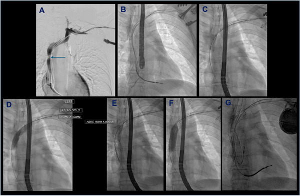 Joint Pacing and Vascular Intervention for the Management of Cardiac Device Associated Central Venous Obstruction.