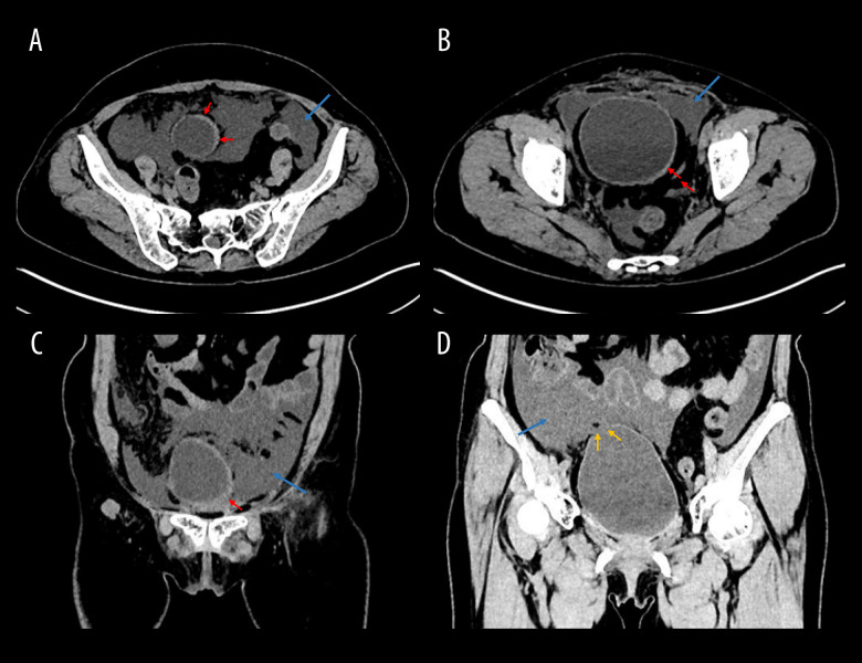 Radiotherapy-Related Bladder Fistula: A Hidden Cause of Recurrent Abdominal Symptoms.