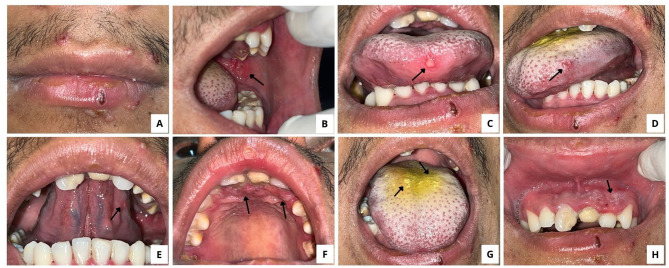 Striking Oral Manifestation of Primary Herpetic Gingivostomatitis: A Case Report and Review of Human Herpesvirus Infections.