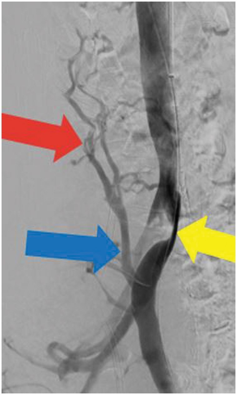 New daily persistent headache with May-Thurner physiology and spinal epidural venous congestion: treatment with ascending lumbar vein embolization.