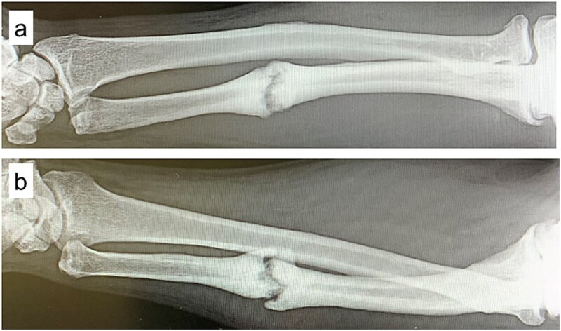Bone union achieved in an ulnar shaft nonunion using dextrose prolotherapy without surgery: a case report.