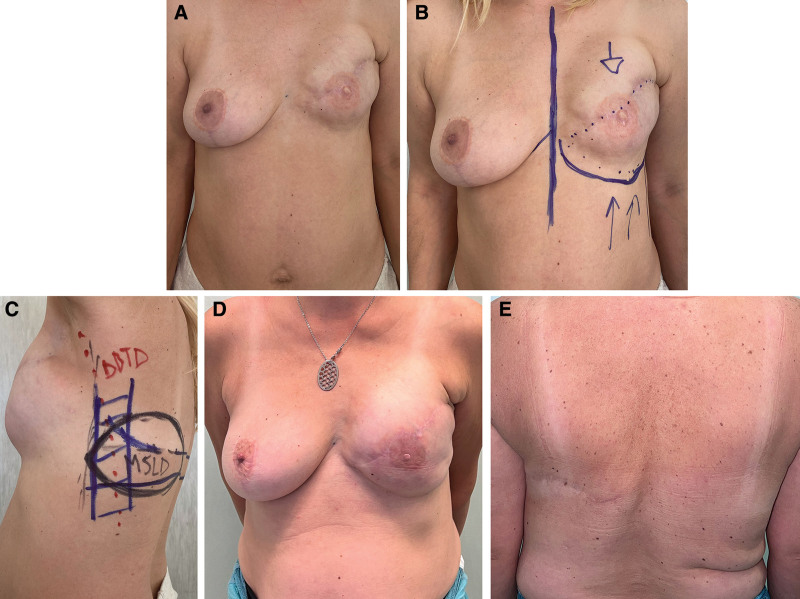 The Versatility of the Fat-extended, Muscle-sparing Latissimus Dorsi Flap in Breast Reconstruction.