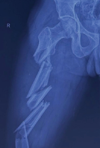 Triple-Segmental Shaft Femur Fracture: A Case Report.
