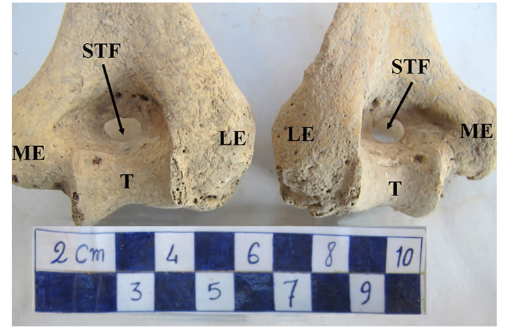 The Supratrochlear Foramen in Iron Age Humerus Remains from Iran: A Paleoepidemiological Case Report.
