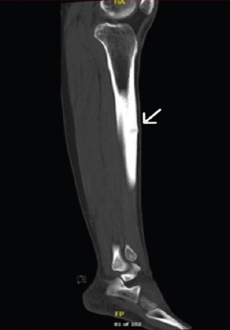 Diagnostic Pitfalls: Anterior Tibial Stress Fracture in a Professional Football Player - A Case Report.