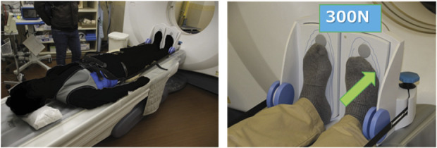 An All-Female Study Quantifying Morphological Differences of the Hindfoot and Posterior Tibialis Muscle Between Patients with Progressive Collapsing Foot Deformity and Asymptomatic Controls.