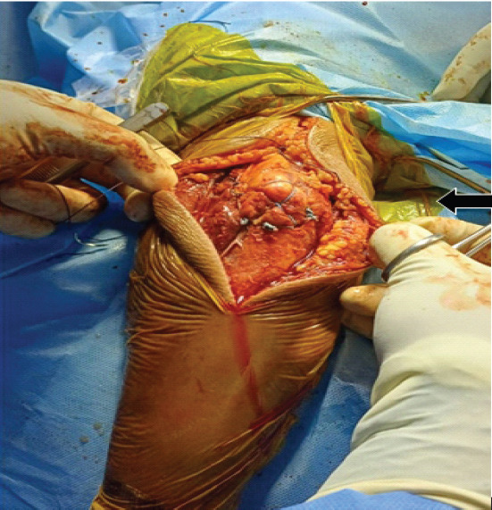 Capitellum Fracture with Distal Triceps Tendon Avulsion Injury: A Rare Presentation with Literature Review.